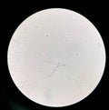 Budding yeast cells with pseudohyphae in urine sample