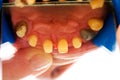 Buffed teeth - prosthetic rehabilitation