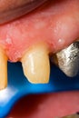 Buffed teeth - prosthetic rehabilitation