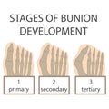 Bunion development