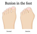 Bunion in the foot