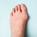 Bunion in foot. Valgus deformation from narrow shoes Royalty Free Stock Photo