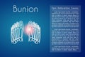 Bunion in foot vector background