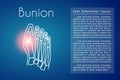 Bunion in foot vector background