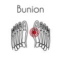 Bunion in foot vector illustration