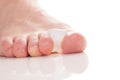 Bunion, hallux valgus. Separator on white. Royalty Free Stock Photo