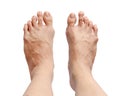 Bunion - hallux valgus on white background and clipping path Royalty Free Stock Photo