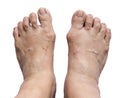 Bunion - hallux valgus on white background