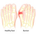 Bunion. Human anatomy. Skeleton Royalty Free Stock Photo