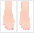 Bunion before and after operation