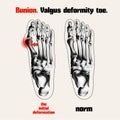 Bunion. Valgus deformity toe. Royalty Free Stock Photo
