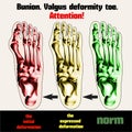 Bunion. Valgus deformity toe.