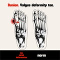 Bunion. Valgus deformity toe.