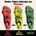 Bunion. Valgus deformity toe. Royalty Free Stock Photo