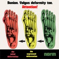 Bunion. Valgus deformity toe.