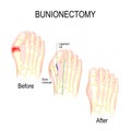 Bunionectomy. surgery to correct pathologies of the foot.