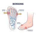 Bunions and bunionette as feet bone disorder condition outline diagram Royalty Free Stock Photo