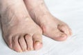 Bunions and hammer toes on feet of senior woman Royalty Free Stock Photo