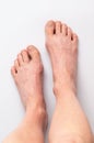 Bunions. Hallux valgus, feet Royalty Free Stock Photo