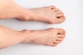 Bunions. Hallux valgus, feet 