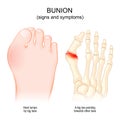 Bunions. Hallux abducto valgus