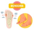 Bunions vector illustration. Labeled feet bone disorder explanation scheme.