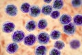 Burkitt`s lymphoma cells, is a cancer of the lymphatic system Royalty Free Stock Photo