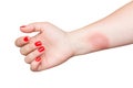 Burn on female hand with red nails isolated on white background Royalty Free Stock Photo