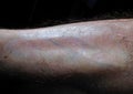 Burn scar on male leg