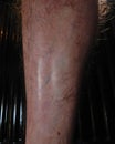 Burn scar on male leg