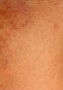 A burn scar that is partly healed