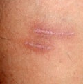 A burn scar that is partly healed Royalty Free Stock Photo