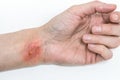 Burn of a skin on womanÃ¢â¬â¢s hand isolated on white, burst blister on female hand injured with boiling water
