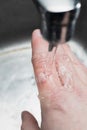 Burned skin on a finger. Caucasian man keeps hand under the cold running water