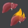 Burning anatomical liver. Realistic human organ of internal digestion system in flame. Vector illustration