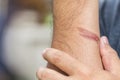 Burning skin on arm, Injury from fire Royalty Free Stock Photo