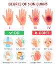 Burns degree. First aid for burn wound. Fire damage to skin classification. Hand blisters. Vector infographic treatment