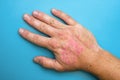 Burns of hand, wounds. Hand with sunburn. Type of burn