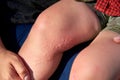 Burns from the nettle grass on the boy`s legs