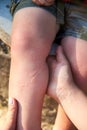 Burns from the nettle grass on the boy`s legs