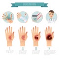 Burns Treatment. Degree of skin burns. Vector infographic. Flat Illustration for websites, brochures, magazines etc Royalty Free Stock Photo