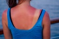 Burnt female skin in the sun close-up in a blue t-shirt