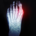 Bursitis of the big toe. Callus on the leg. X-ray of the foot with the designation of the sore spot