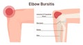 Bursitis. Elbow joint inflammation. Inflamed or irritated bursae of synovial