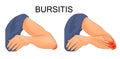 Bursitis of the elbow joint