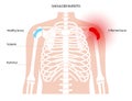 Bursitis inflammation concept