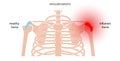 Bursitis inflammation concept