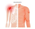 Bursitis inflammation concept