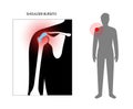 Bursitis inflammation concept