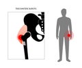 Bursitis inflammation concept